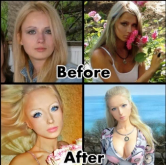 Валерия Лукянова преди и след операциите
